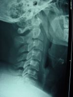 Luis Lopez Cervical Lateral.JPG Luis Lopez Cervical Lateral.JPG